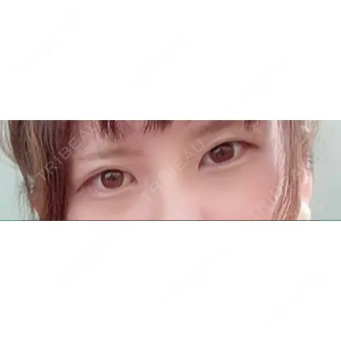 二重埋没 / 脂肪吸引（顔） / ボトックス（エラ・小顔） 藤・ナチュレ美容クリニック 恵比寿院 AFTER
