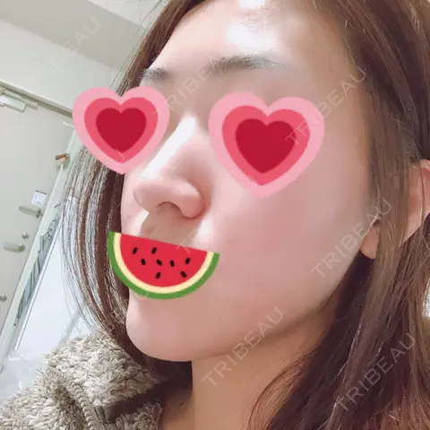 隆鼻術 / 鼻尖形成（切開） / 鼻修正 / 鼻尖縮小 / 鼻翼基部形成（貴族手術） サラ美容外科 AFTER
