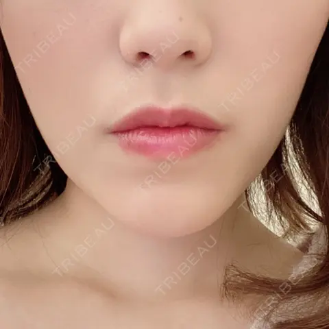 ボトックス（エラ・小顔） 湘南美容クリニック 新宿本院 AFTER