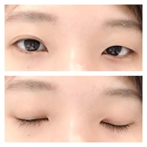 眼瞼下垂（切開） 蘇春堂形成外科 AFTER