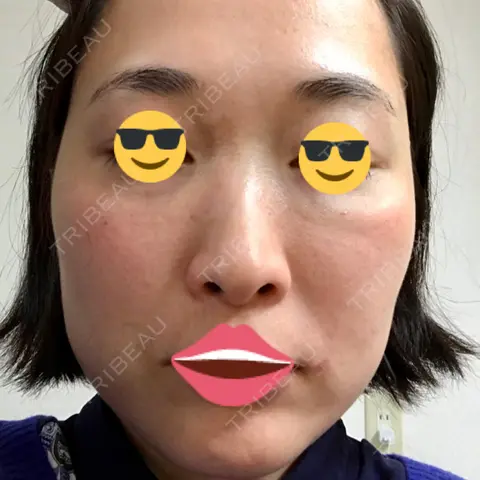 水光注射（ハリ・美肌） 銀座国際美容外科 池袋院 AFTER