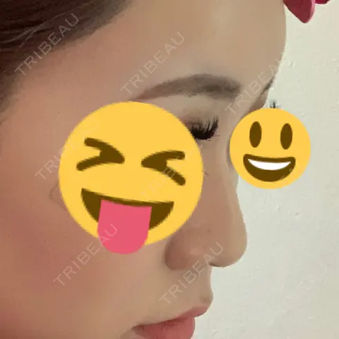 隆鼻術 / 軟骨移植 / ワシ鼻修正・ハンプ切除 / 鼻翼基部形成（貴族手術） / その他（目元） NANA（ナナ）美容外科 AFTER