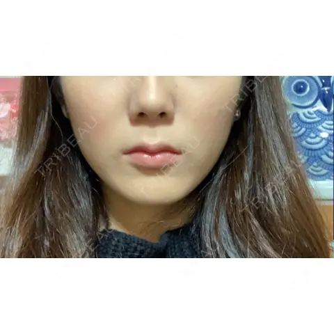 脂肪溶解注射（顔） 赤坂プレミアクリニック AFTER