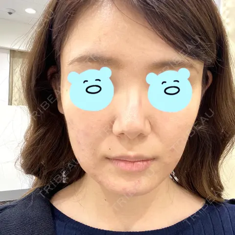 脂肪溶解注射（顔） 湘南美容クリニック 西宮北口院 AFTER