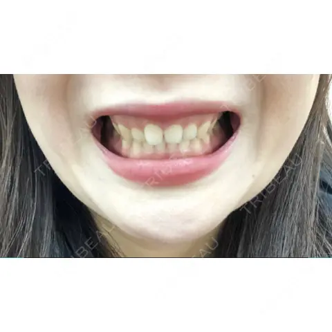 その他（審美歯科/矯正歯科） 南青山矯正歯科 AFTER