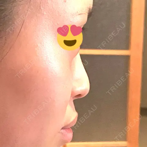 隆鼻術 湘南美容クリニック 広島院 AFTER