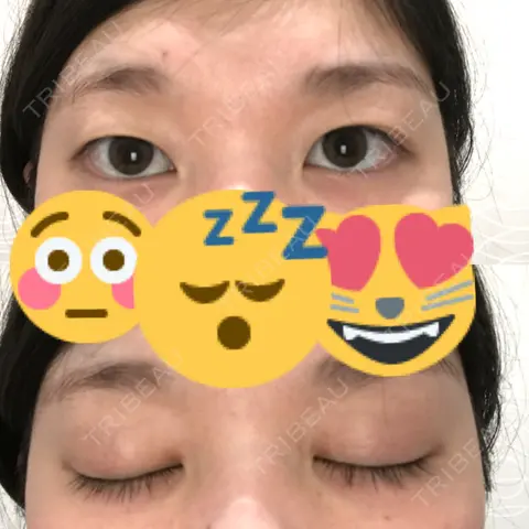二重埋没 湘南美容クリニック 奈良院 AFTER