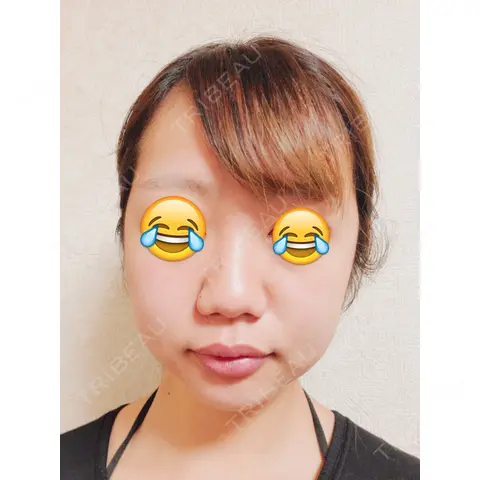 隆鼻術 / 鼻尖形成（切開） / 鼻中隔延長（切開） / 小鼻縮小（切開） / 軟骨移植  AFTER