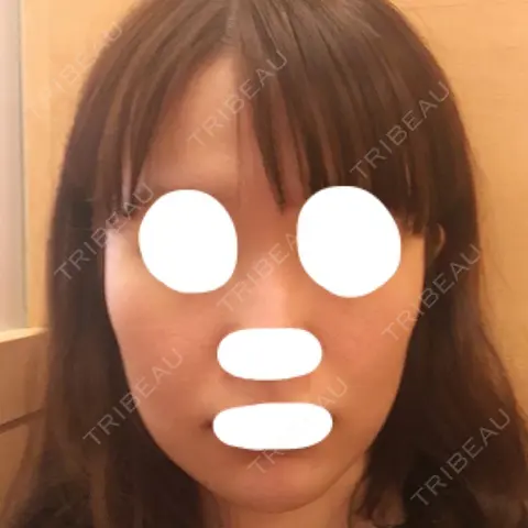骨削り（頬） TL美容整形外科 顔面輪郭・目・鼻センター AFTER