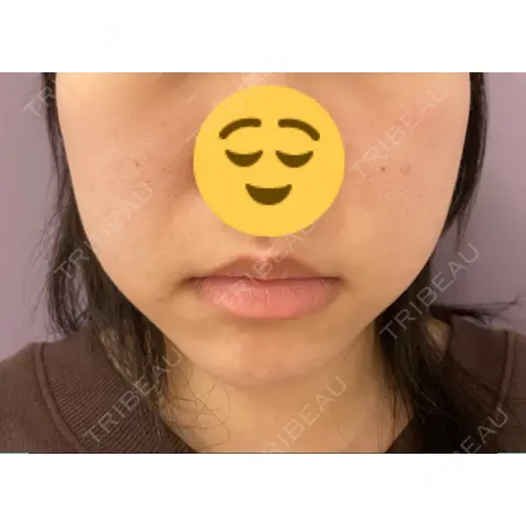 糸リフト / バッカルファット除去 / 脂肪吸引（顔） / ボトックス（エラ・小顔） 藤・ナチュレ美容クリニック 恵比寿院 AFTER