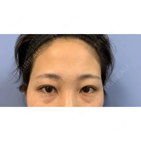 クマ治療 / 額を丸く / 下まぶたたるみ取り / 脂肪注入（額） / 脂肪注入（輪郭） 湘南美容クリニック 品川院 AFTER