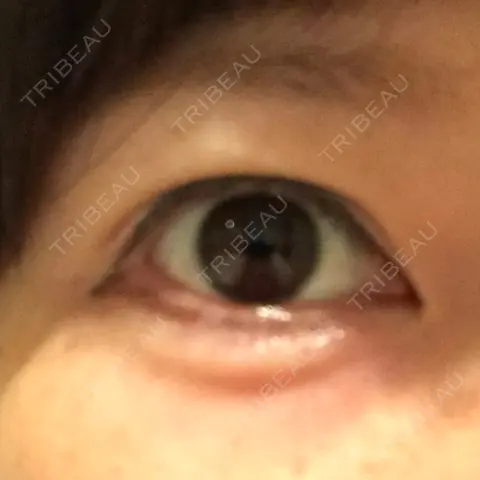 二重切開 リビジョンクリニック（旧：池本形成外科・美容外科） AFTER