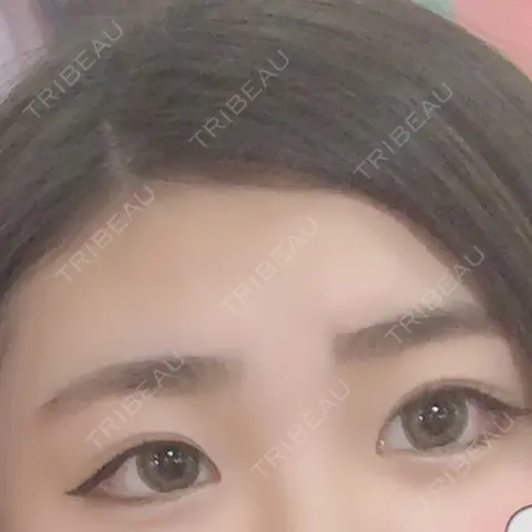 ヒアルロン酸注入（涙袋） / ヒアルロン酸注入（鼻）  AFTER