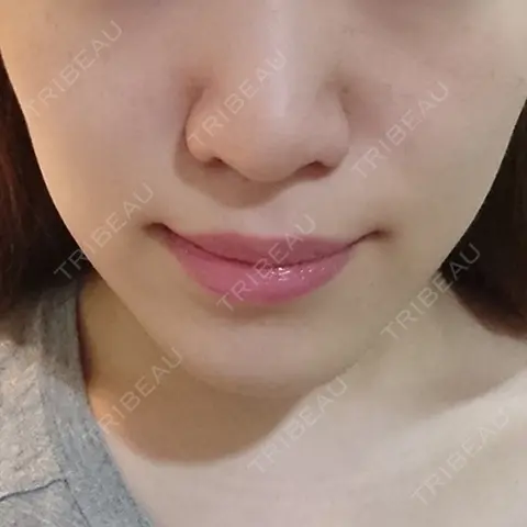 糸リフト WIZ＆美 美容外科・皮膚科 AFTER