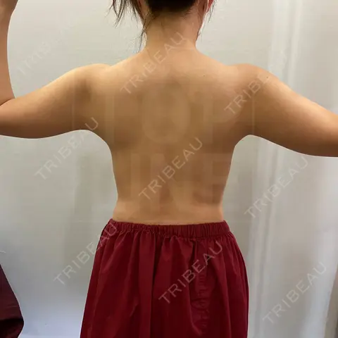 脂肪吸引（二の腕） 狎鴎亭トップライン医院 AFTER