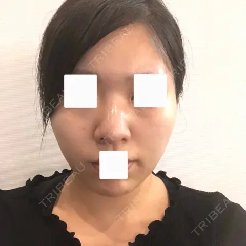 隆鼻術 / 鼻尖形成（切開） / 鼻中隔延長（切開） / 小鼻縮小（切開） / 軟骨移植 / 骨切幅寄せ / ワシ鼻修正・ハンプ切除 / 鼻修正 View美容整形外科 AFTER