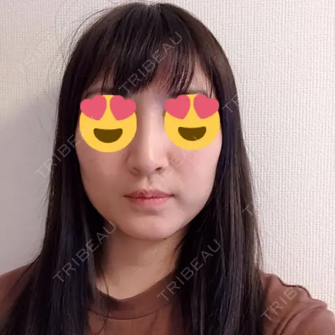 肌ヒアルロン酸注入（たるみ・シワ改善） / ボトックス（エラ・小顔） / 脂肪溶解注射（顔） 湘南美容クリニック 岡山院 AFTER