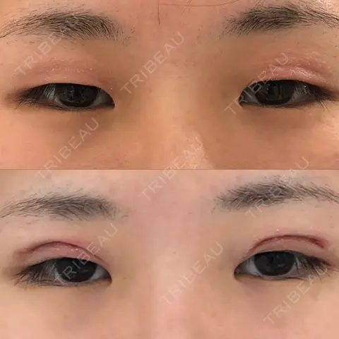 二重埋没 BIANCA銀座 AFTER