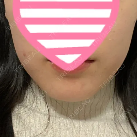 脂肪吸引（顔） アサミ美容外科 大阪院 AFTER