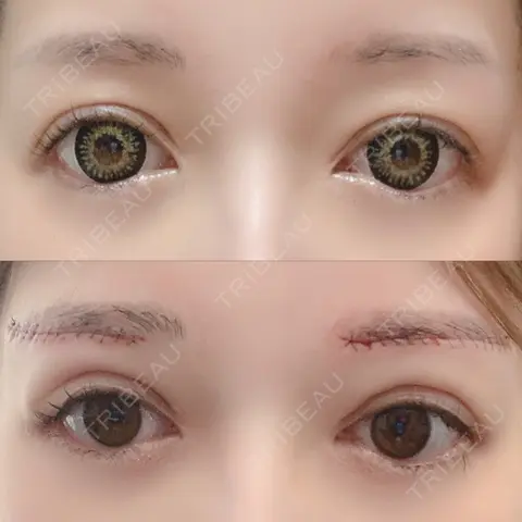 眉下切開 福岡TAクリニック AFTER