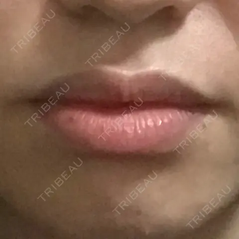 口角挙上 福岡TAクリニック AFTER