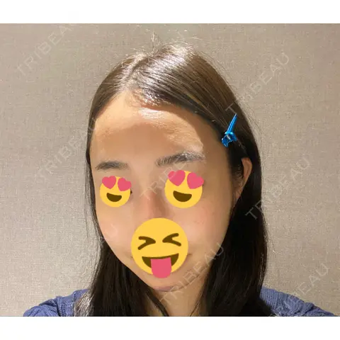 骨切り（あご） / 骨削り（エラ） / 骨削り（頬） / 輪郭修正 DI（ディアイ）整形外科 AFTER