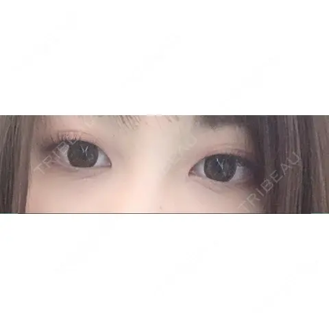 二重埋没 東京イセアクリニック AFTER