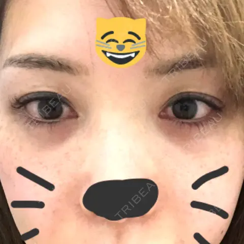 タレ目形成・グラマラスライン（切開） B-LINE CLINIC 池袋院 AFTER