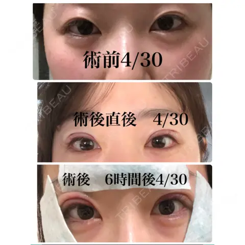二重切開 広島中央クリニック AFTER
