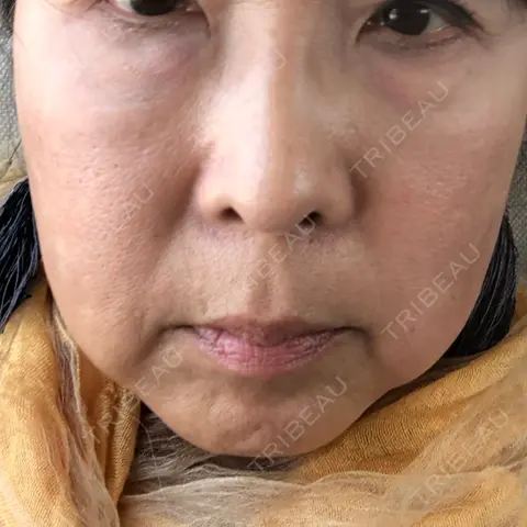 糸リフト / 下まぶたの脂肪取り TCB東京中央美容外科 京都駅前院 AFTER