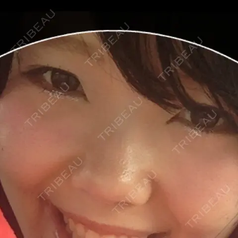 二重切開 高須クリニック 名古屋院 AFTER