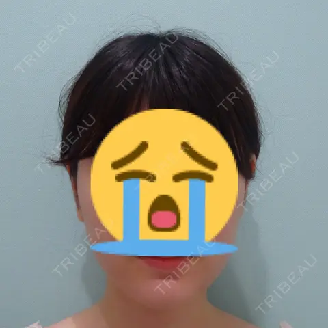 脂肪吸引（顔） / メーラーファット除去 / ボトックス（エラ・小顔） WOM CLINIC GINZA （ワム クリニック ギンザ） AFTER