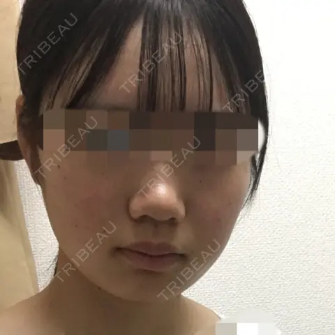 脂肪吸引（顔） アサミ美容外科 大阪院 AFTER