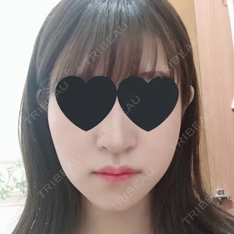 鼻尖形成（切開） / 鼻中隔延長（切開） / 小鼻縮小（切開） / 軟骨移植 / 骨切幅寄せ / 眉間プロテーゼ / プロテーゼ除去 / 鼻修正 / 鼻尖縮小 / その他（鼻） FROM B整形外科 (旧バウム整形外科) AFTER