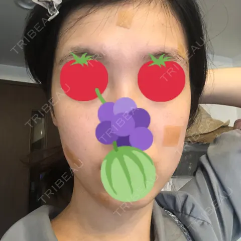 ほくろ・いぼ切除（肌） / ほくろ・いぼ除去レーザー（肌） 高梨医院 皮膚科・美容皮膚科 AFTER
