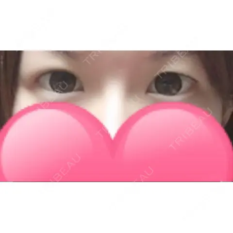 二重埋没 湘南美容クリニック 熊本院 AFTER