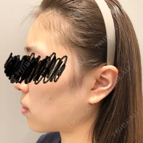 その他（輪郭） Beauty Connection Ginza Clinic（BCGクリニック） AFTER