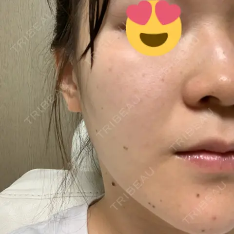 ほくろ・いぼ切除（肌） 銀座国際美容外科 池袋院 AFTER