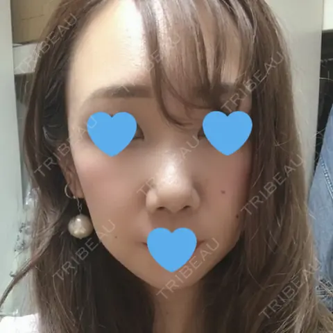 鼻尖形成（切開） / 軟骨移植 / 眉間プロテーゼ / 鼻尖縮小 湘南美容クリニック 柏院 AFTER