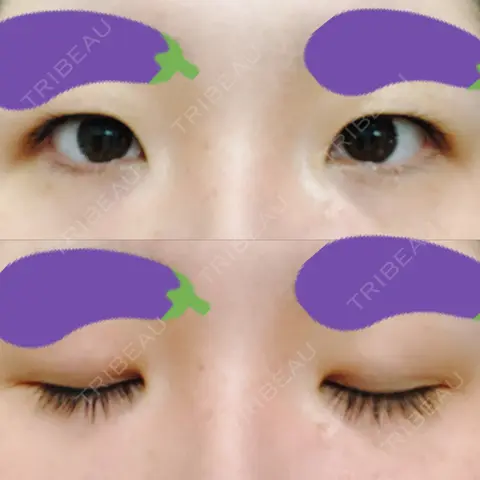 二重埋没 / 上まぶたの脂肪取り / ヒアルロン酸注入（目の下） 大塚美容形成外科 京都院 AFTER