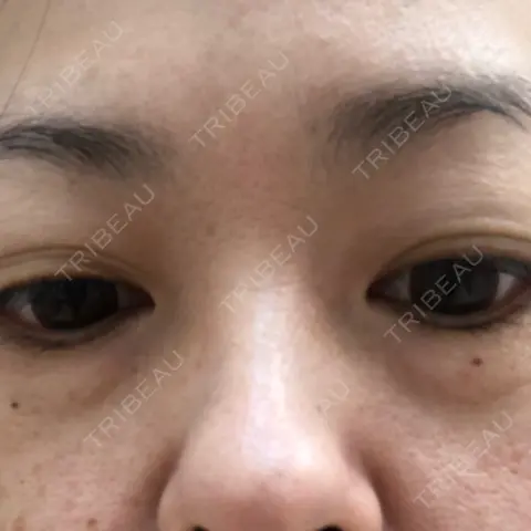 下まぶたの脂肪取り 水戸中央美容形成クリニック AFTER
