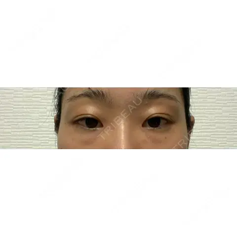 下まぶたの脂肪取り SOグレイスクリニック 御殿山 AFTER