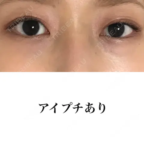 二重埋没 A CLINIC（エークリニック） 銀座院 AFTER