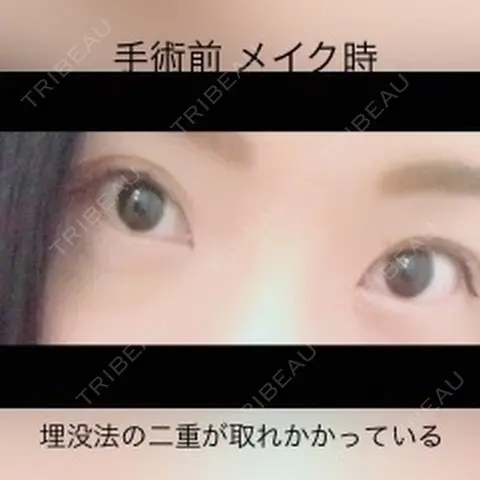二重切開 / 目頭切開 品川美容外科 千葉院 AFTER