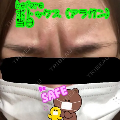 シワ取りボトックス 品川美容外科 千葉院 AFTER