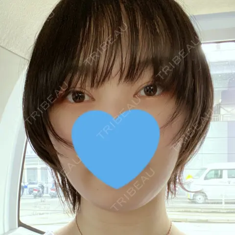 バッカルファット除去 TCB東京中央美容外科 京都駅前院 AFTER