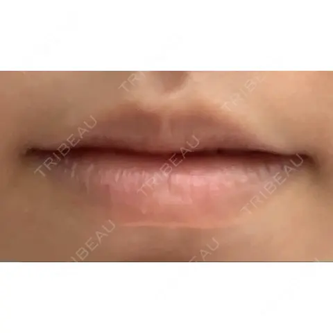 アートメイク（唇） LETICIA CLINIC（レティシア クリニック） AFTER