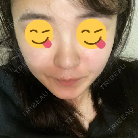 隆鼻術 湘南美容クリニック 岡山院 AFTER