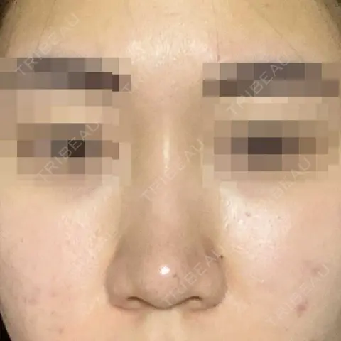隆鼻術 / 軟骨移植 エイト美容外科 AFTER