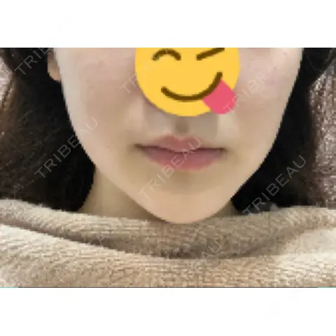 ボトックス（エラ・小顔） 銀座よしえクリニック 表参道院 AFTER